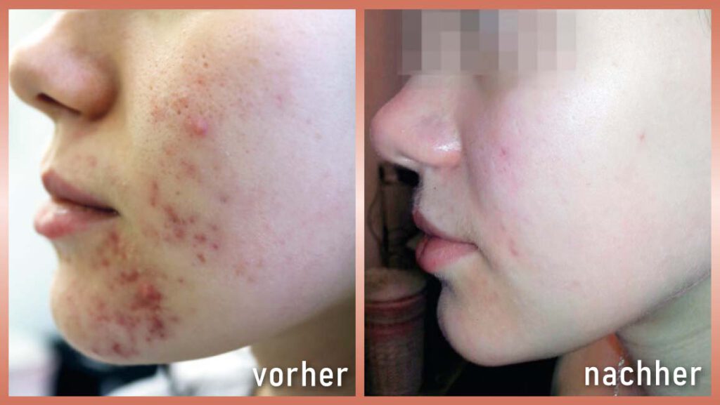 Schrammek Green Peel vorher-nachher Foto 1