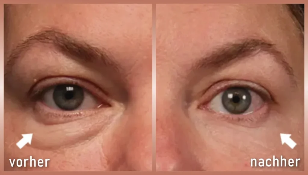 Vorher-Nachher Bild Radiofrequenz Microneedling Augenpartie