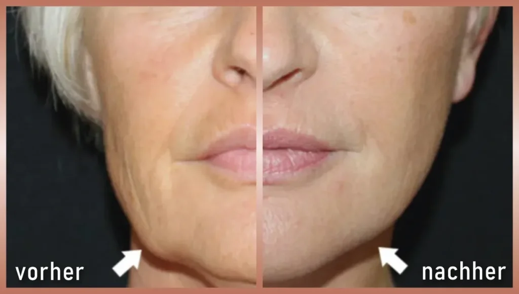 Vorher-Nachher Bild Radiofrequenz Microneedling Halspartie