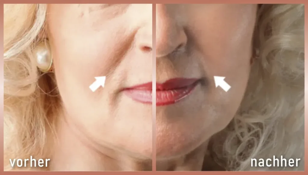 Vorher-Nachher Bild Radiofrequenz Microneedling Mundpartie