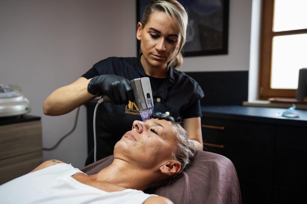 Radiofrequenz Microneedling Gesicht