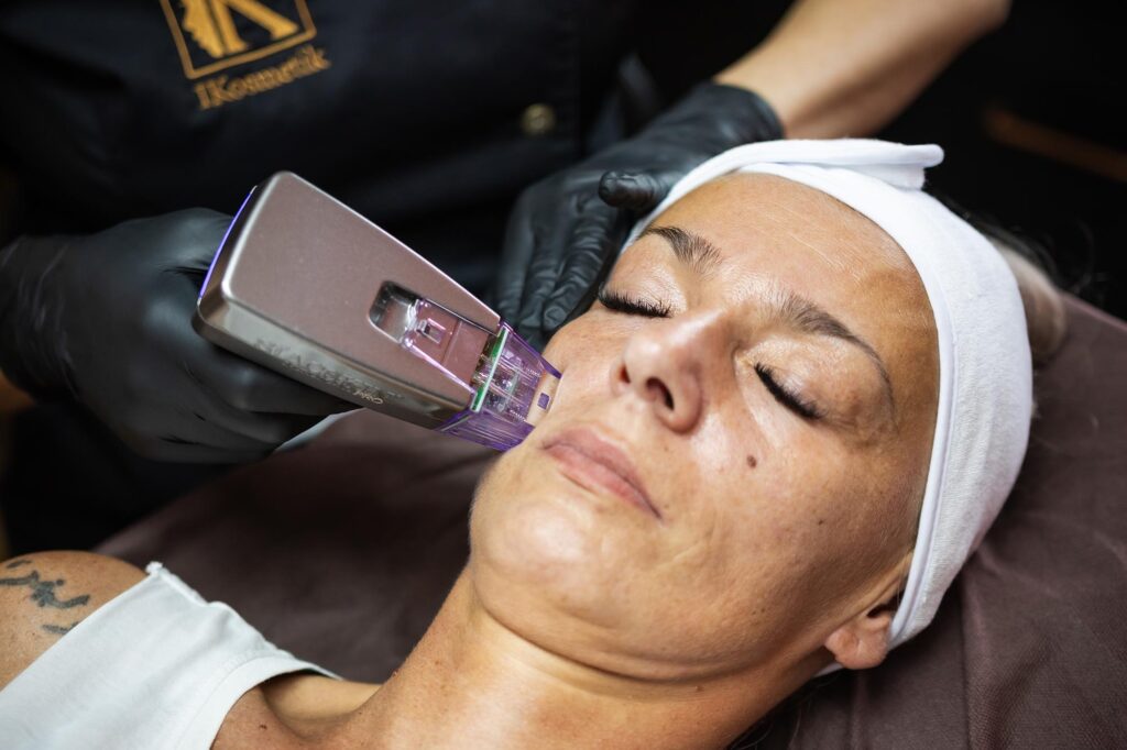 Radiofrequenz Microneedling Gesicht