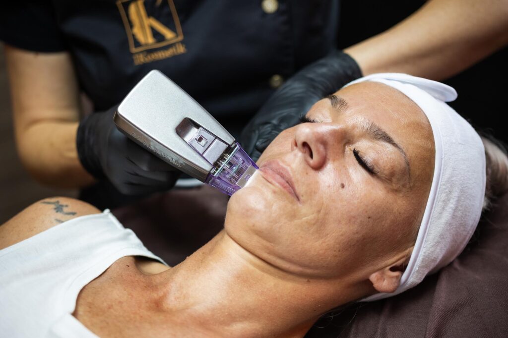 Radiofrequenz Microneedling Gesicht
