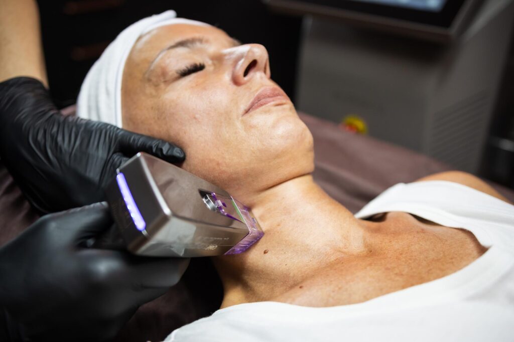 Radiofrequenz Microneedling Hals