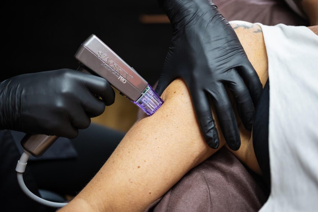 Radiofrequenz Microneedling Oberarm