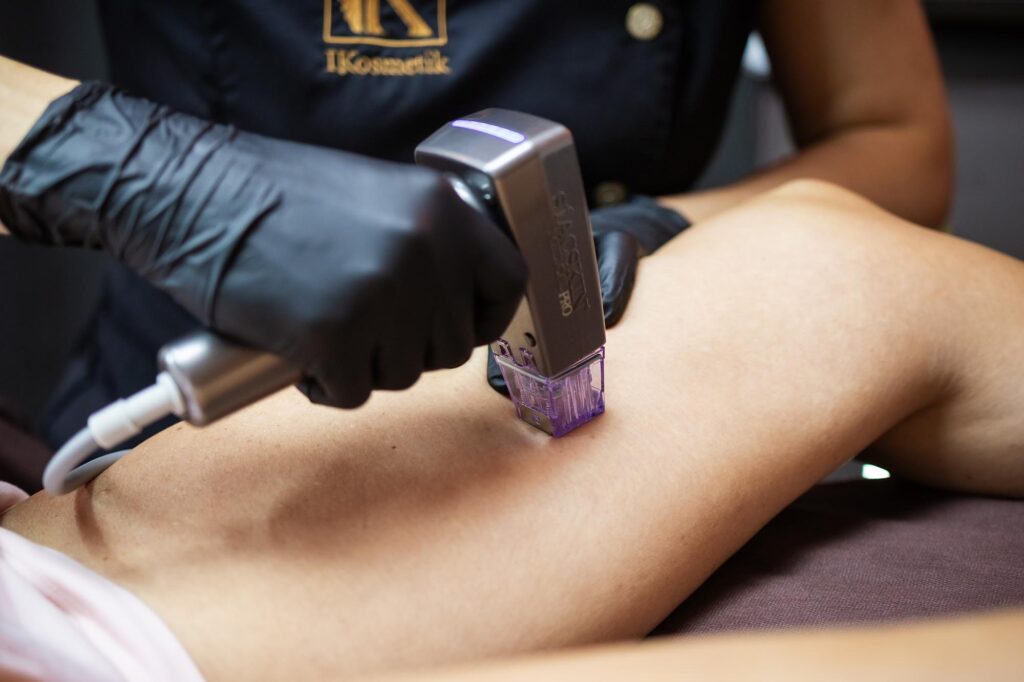 Radiofrequenz Microneedling Innenschenkel