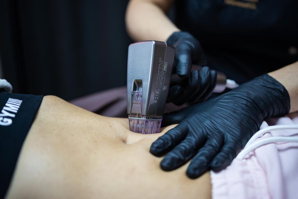 Radiofrequenz Microneedling Bauch