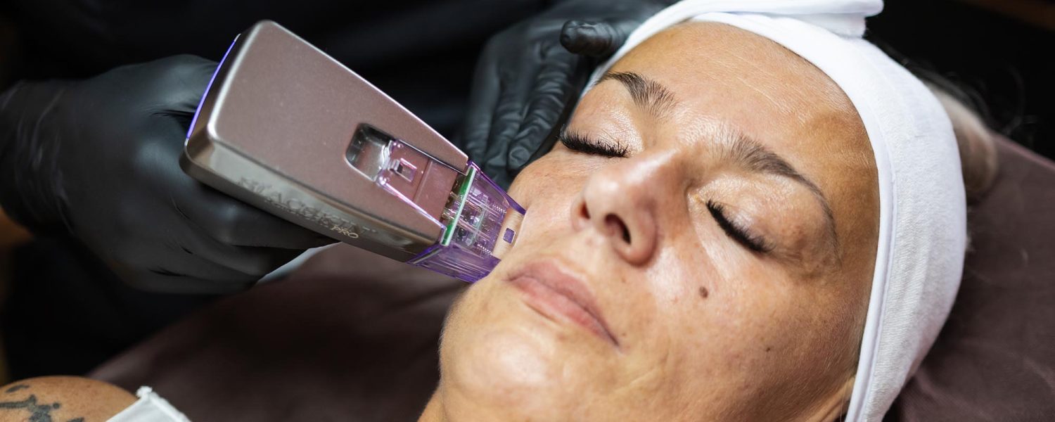Radiofrequenz Microneedling Gesicht